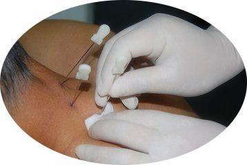 颈椎小针刀手术视频,颈椎小针刀手术操作步骤及技巧解析